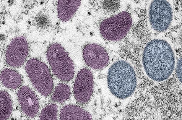 Caso suspeito de varíola dos macacos em Cruz Alta não se confirma após exame