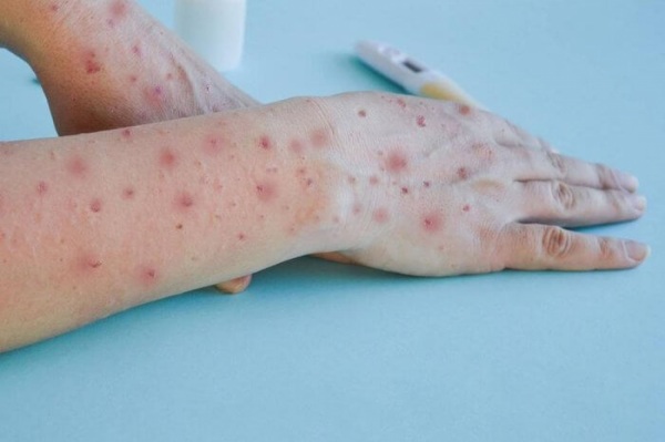 SAÚDE> Passo Fundo registra primeiro caso de mpox em 2024