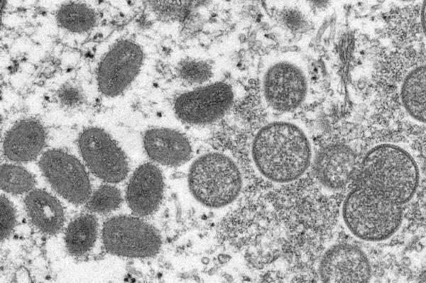 Argentina confirma primeiro caso de varíola do macaco na América Latina